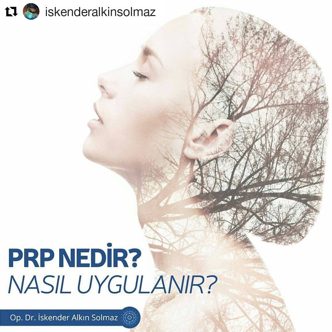 #Repost @iskenderalkinsolmaz (@get_repost)
・・・
Gençleşmenin en doğal yollarından biri olan  PRP tedavisi, güneş ışınları, sigara kullanımı,  gebelik, stresli yaşam ve beslenme düzeninin  dengesizliği gibi birçok etken sebebiyle  yıpranan cildin kaybettiği yapıları geri  kazanmasını sağlar.Kolunuzdan alınan çok  az miktarda (10 cc) kan, santrifüj cihazında  yüksek devirde çevrilerek, platelet adındaki  kan hücrelerin büyüme faktörleri bakımından  zengin plazma kısmı elde edilir. Bu plazma  ihtiyaç duyulan cilt bölümlerine enjekte  edilerek, cildimizi oluşturan ana yapılardan  olan kollajen ve elastin artışı en doğal yolla  tetiklenmiş olur.Bu tedaviyi Dünya Göz Etiler şubemizde uygulamaya başlamış bulunmaktayız #driskenderalkınsolmaz #iskenderalkınsolmaz #dünyagözestetik #dünyagözetiler #dünyagöz #okuloplasti #oküloplastikcerrahi #prptedavisi #prp