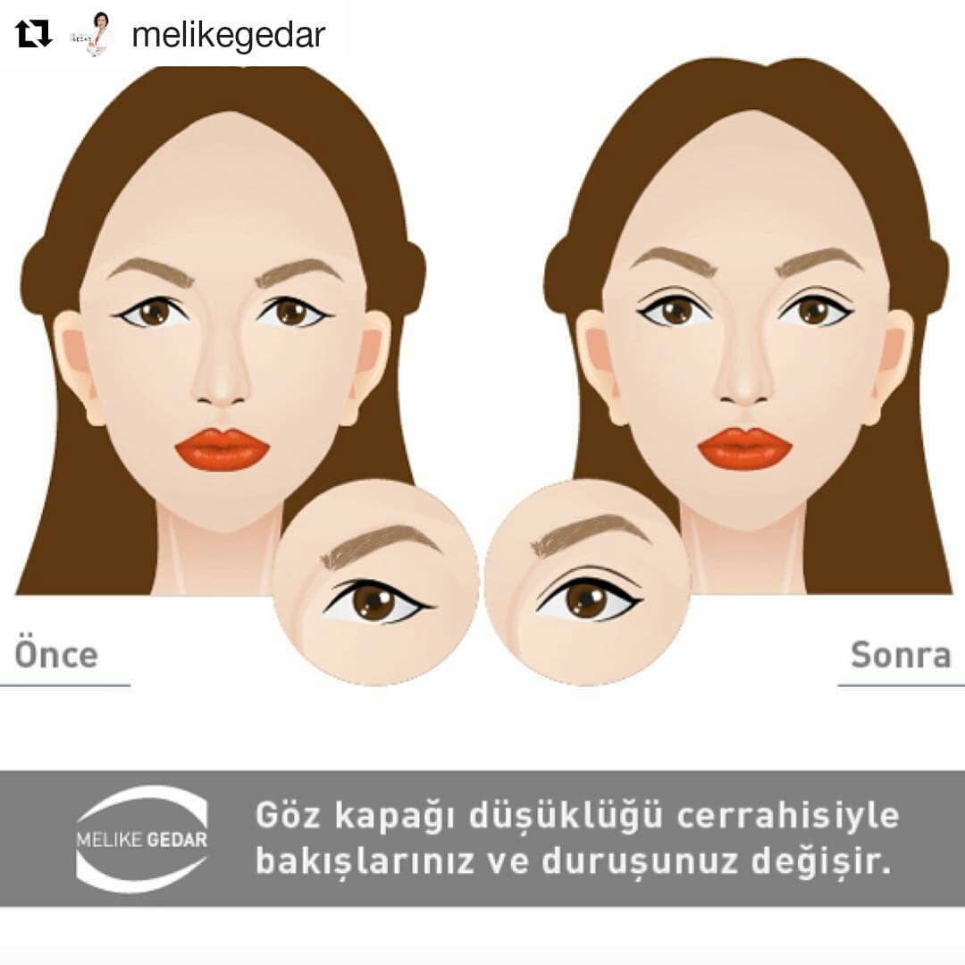 #Repost @melikegedar (@get_repost)
・・・
Göz kapağı düşüklüğünü giderdiğimiz hastaların sadece bakışlarının değil vücut postürlerinin de değiştiğini, kendilerine olan güvenlerinin arttığını sevinerek gözlemliyoruz. #DrMelikeGedar #dünyagöz #dünyagözataköy #gözsağlığı #eye #gözdoktoru #gözkapağıdüşüklüğü #oküloplasti #oculoplasti