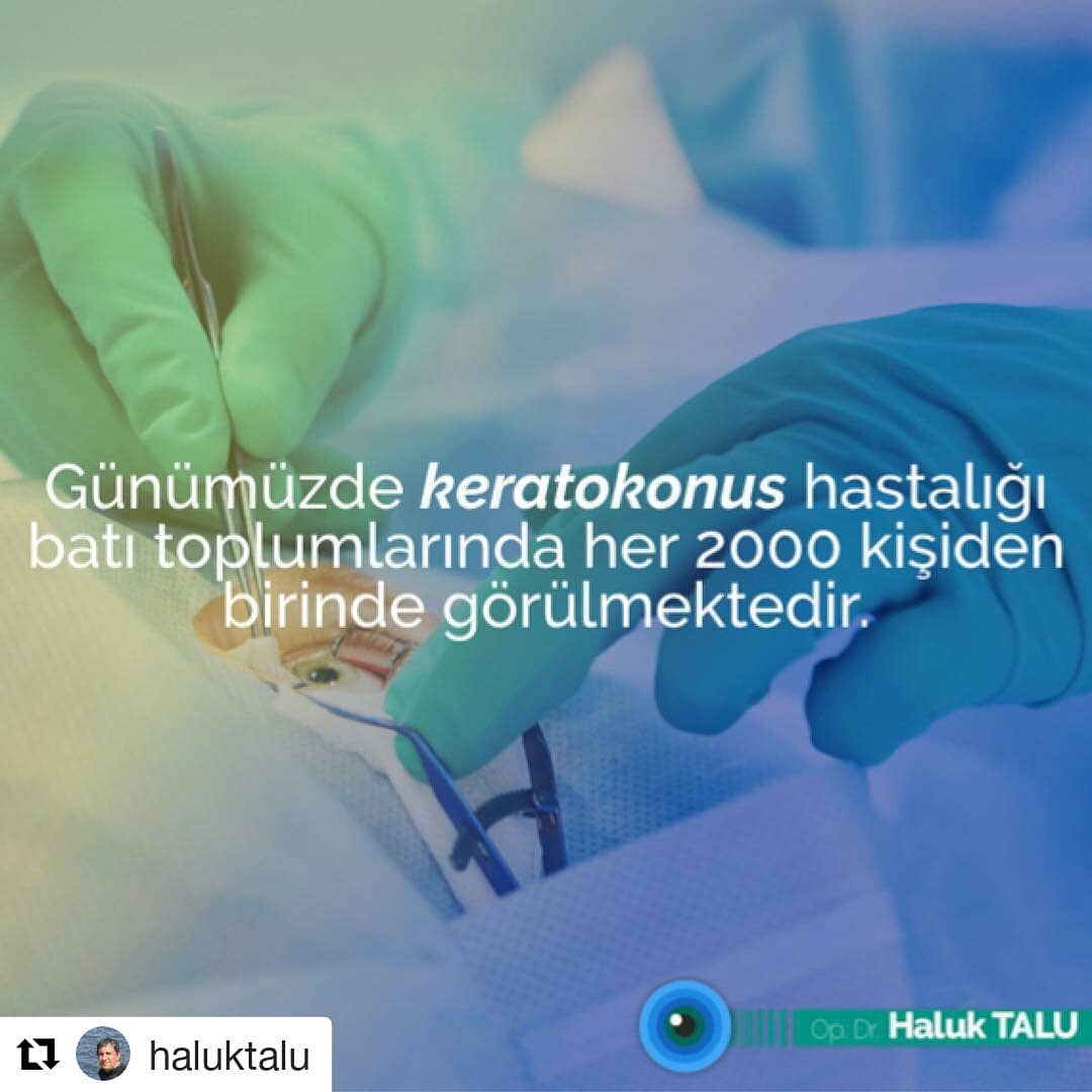 #Repost @haluktalu (@get_repost)
・・・
Keratokonus’un görülme sıklığı her geçen yıl daha da artıyor. İlerleyen miyop ve astigmat, kornea incelmesi ve sivrileşmesi ile belirti vermeye başlayan keratokonus hastalığına, çok özel tetkiklerle erken dönemde teşhis konulabildiği için, miyop ve astigmat rahatsızlığı bulunan kişilerin, düzenli göz muayenelerini yaptırmaları çok önemli. #DünyaGözAtaköy #HalukTalu #Gözdoktoru #dunyagozhastanesi #keratokonus #erkenteşhis