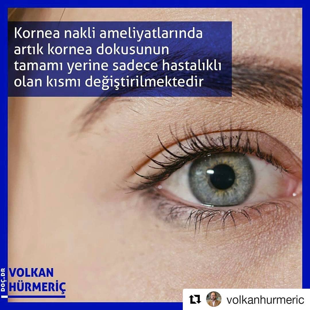#Repost @volkanhurmeric (@get_repost)
・・・
Bazı hastalıklardan dolayı saydamlığını kaybeden kornea dokusunun değiştirilmesi için kornea nakli ameliyatları uzun yıllardır yapılmaktadır. Ancak günümüzdeki kornea ameliyatlarında korneanın tamamını değil, sadece hastalıklı olan kısmını değiştiriyoruz. Bu sayede vücudun korneayı reddetme ve göz tansiyonu ihtimalini aza indiriyoruz. #DrVolkanHurmeric #dünyagöz #dünyagözankara #gözdoktoru #katarakt #lazertedavisi #lasik #keratokonus #toriklens #keratoplasti #kornea #korneanakli